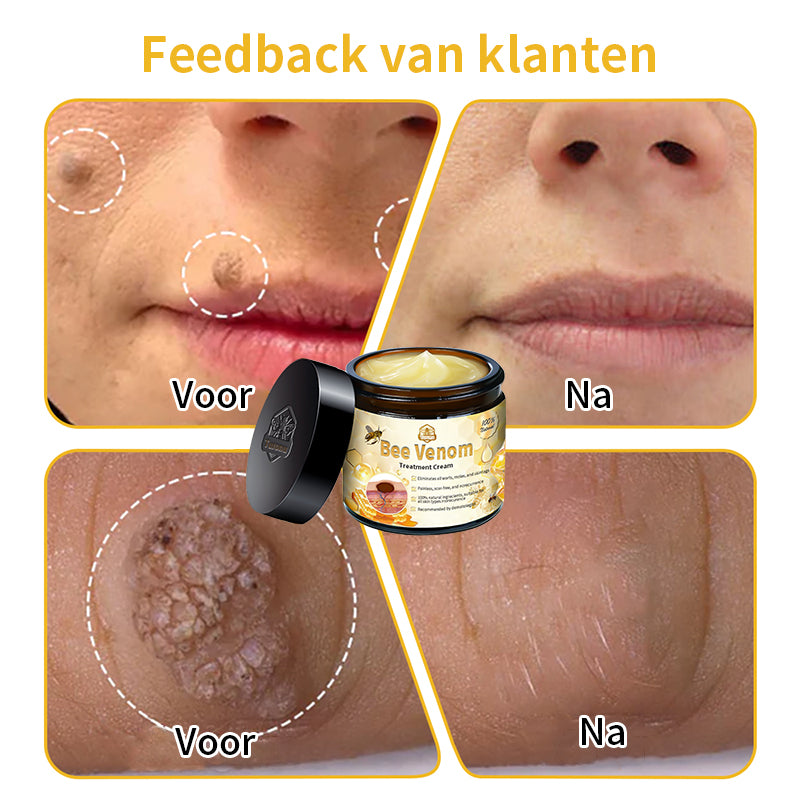 ⭐𝑇𝑢𝑟𝑜𝑛𝑢™ Bijengif Huidbehandelingscrème💌(aanbevolen door EMA)