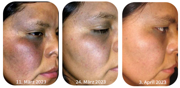 ⭐Last Day Sale-80% OFF) - LEFUN® Melanin korrigierende Creme