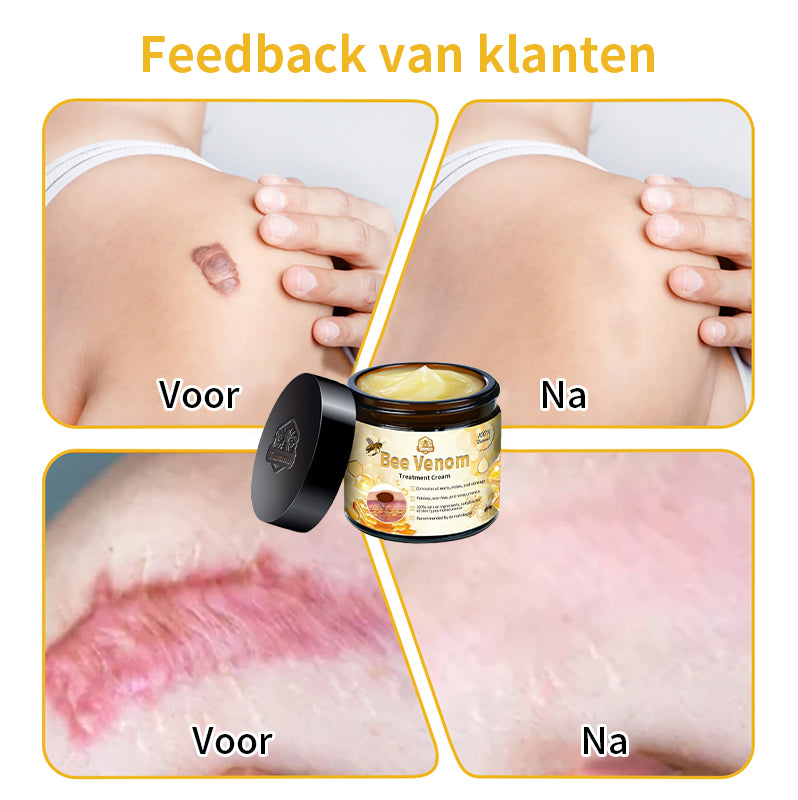 ⭐𝑇𝑢𝑟𝑜𝑛𝑢™ Bijengif Huidbehandelingscrème💌(aanbevolen door EMA)