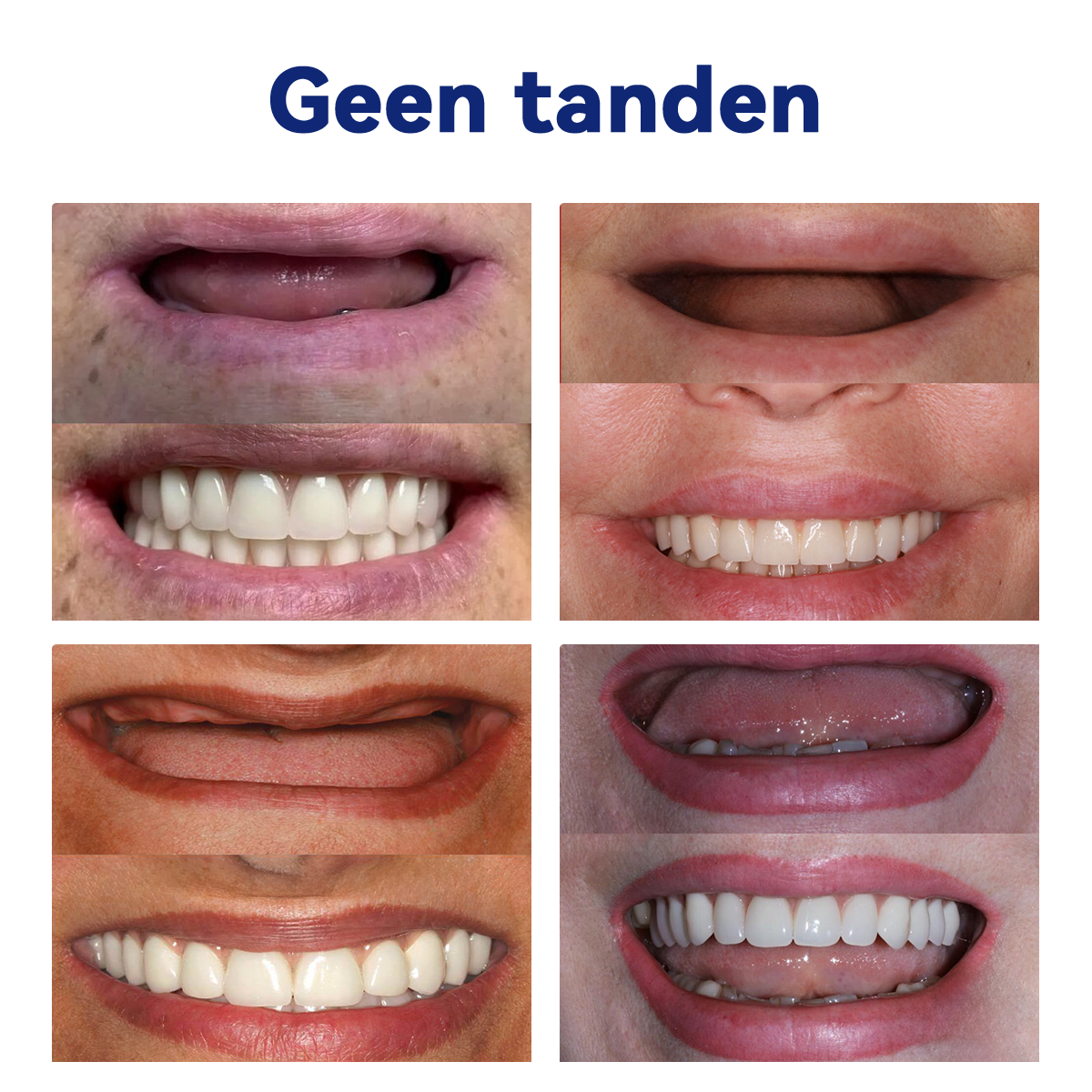HEATWOLF® 💎Premium Geavanceerd Op Maat Gemaakt Volledig Kunstgebit Set💎 (⏰Tijdelijke korting, nog 30 minuten!)