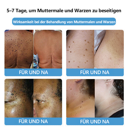 🐝🐝[👑Offizieller Markenshop👑] Lenaro™ Bienengift Maulwurf und Warze Behandlung Creme(👨‍⚕AAD EMPFIEHLT)