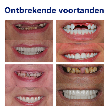 𝐵𝑖𝑘𝑒𝑛𝑑𝑎™ Silicium Prothese Meetset 👩‍🔬 Erkend door de Nederlandse Vereniging voor Tandheelkunde en goedgekeurd door de MDR）