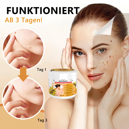 🐝🐝[👑Offizieller Markenshop👑] Lenaro™ Bienengift Maulwurf und Warze Behandlung Creme(👨‍⚕AAD EMPFIEHLT)